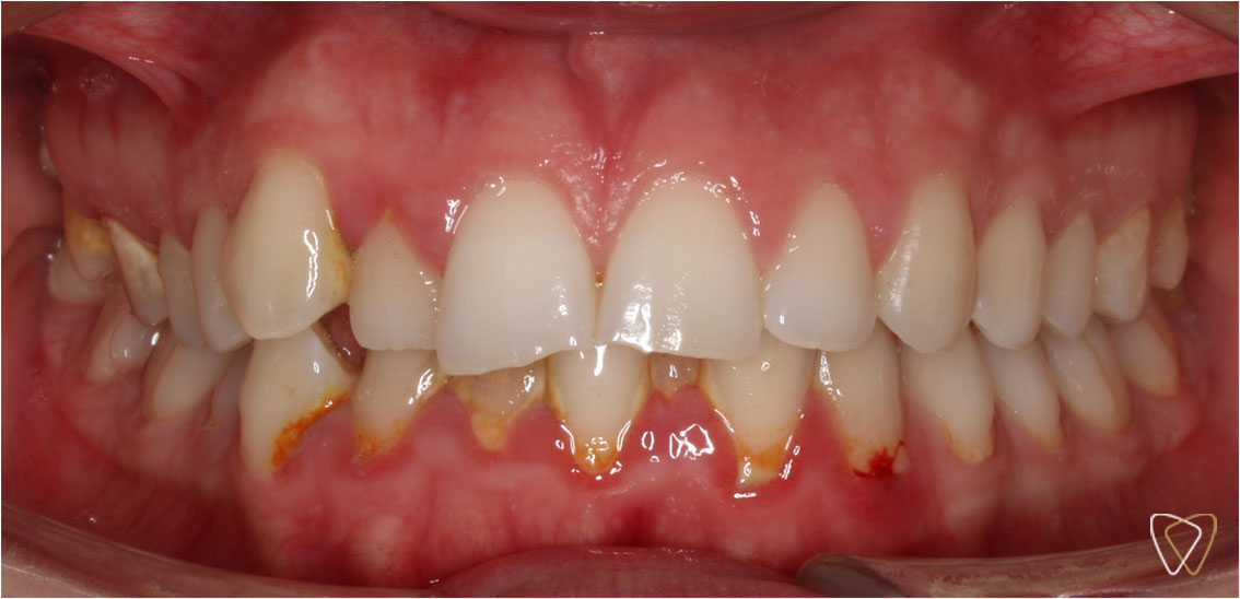 Antes y Despues Ortodoncia Invisalign